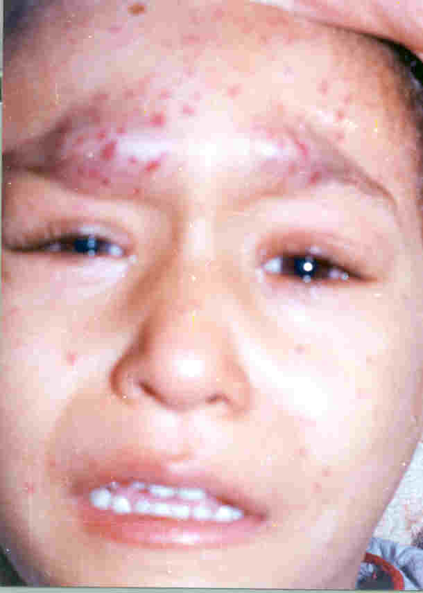 Oculo-facial and Trunk Birthmarks: Should be Indicators of Malignancy ?